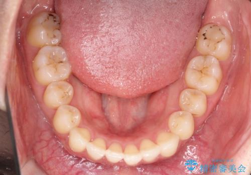 前歯のがたがた気になる　インビザラインによる矯正治療の治療後