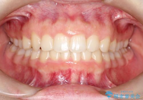 押しつぶされた歯列、アーチの拡大だけで非抜歯で改善した症例の症例 治療後