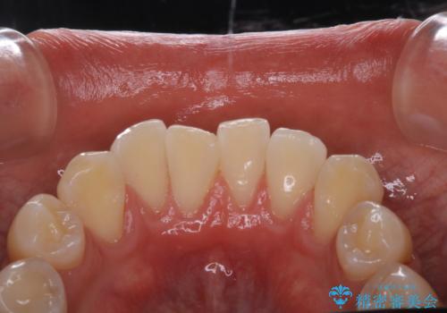 コーヒーの着色が前歯について目立つの治療後
