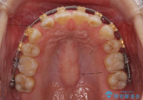 【難症例】歯並びが悪く、虫歯の治療ができない 矯正治療からスタートの治療中