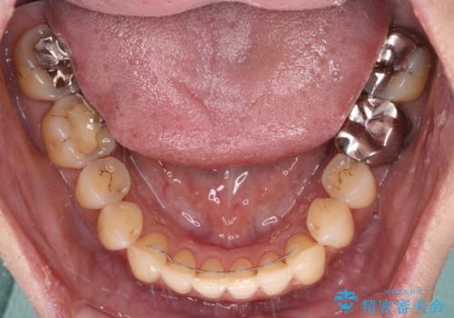 リスク回避 ワイヤー矯正を併用したインビザライン矯正治療の治療後