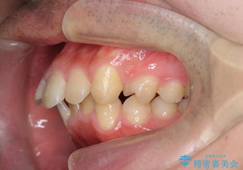 ガタつきの大きい前歯　インビザラインによるマウスピース矯正治療の治療前