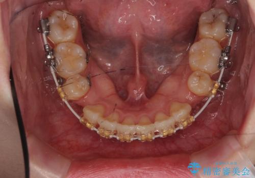 【難症例】歯並びが悪く、虫歯の治療ができない　矯正治療からスタートの治療中