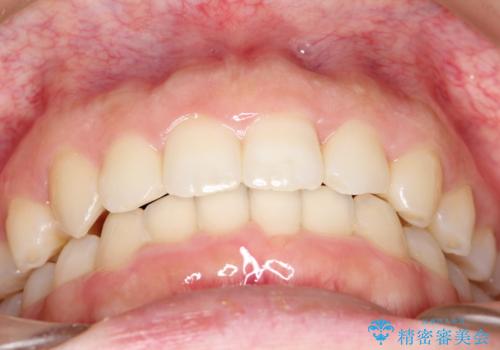 押しつぶされた歯列、アーチの拡大だけで非抜歯で改善した症例の治療後