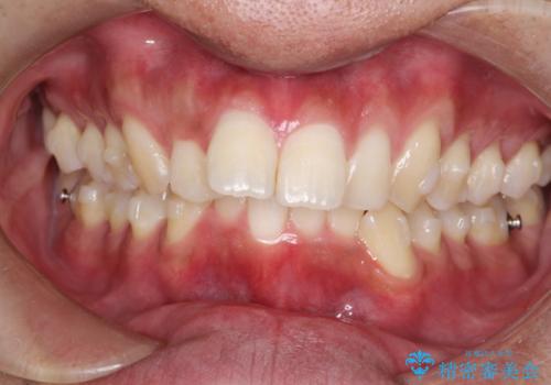 インビザラインによる出っ歯の矯正の治療中