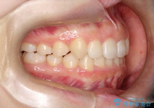 押しつぶされた歯列、アーチの拡大だけで非抜歯で改善した症例の治療後