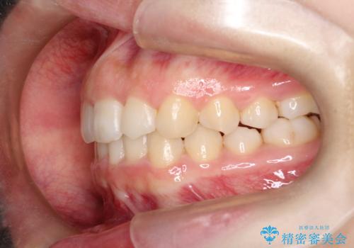 押しつぶされた歯列、アーチの拡大だけで非抜歯で改善した症例の治療後