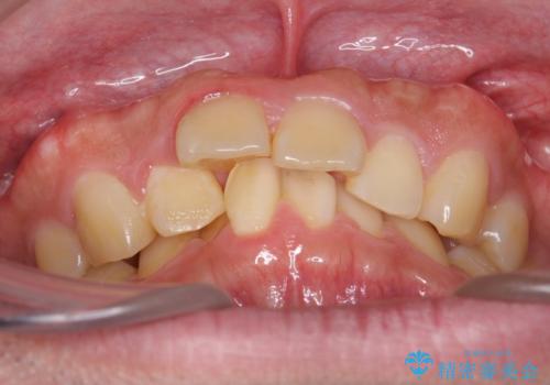 出っ歯を治したい 深いかみあわせ インビザラインで治療の治療前
