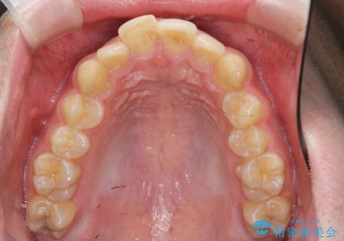 ガタつきの大きい前歯 インビザラインによるマウスピース矯正治療の治療前