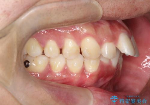 インビザラインによる出っ歯の矯正の治療中