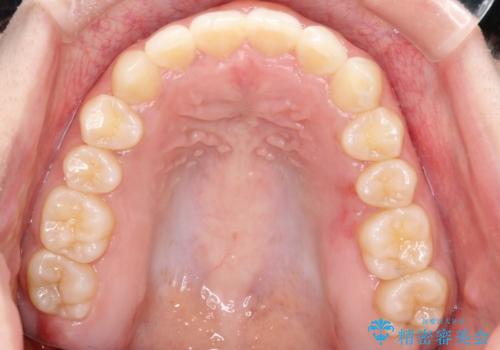 押しつぶされた歯列、アーチの拡大だけで非抜歯で改善した症例の治療後
