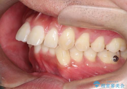 インビザラインによる出っ歯の矯正の治療中