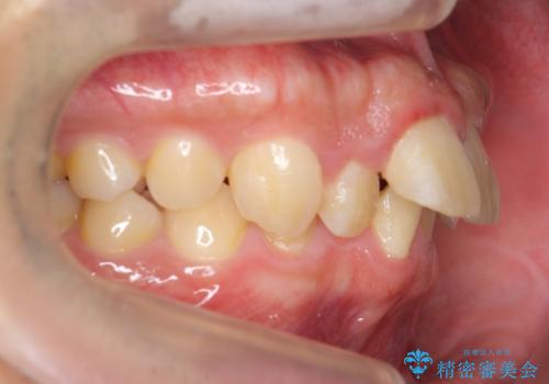 出っ歯を治したい 深いかみあわせ インビザラインで治療の治療前