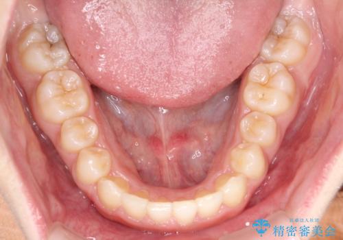 押しつぶされた歯列、アーチの拡大だけで非抜歯で改善した症例の治療後