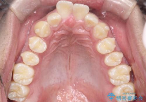 インビザラインによる出っ歯の矯正の治療中
