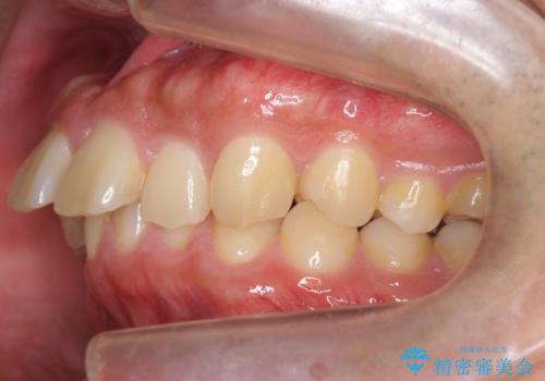 出っ歯を治したい 深いかみあわせ インビザラインで治療の治療前