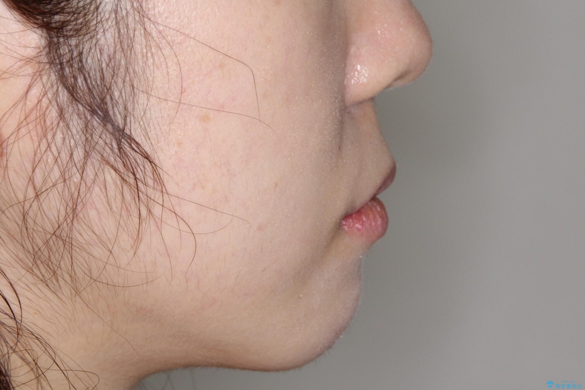 押しつぶされた歯列、アーチの拡大だけで非抜歯で改善した症例の治療後(顔貌)