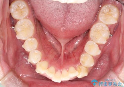 インビザラインによる出っ歯の矯正の治療中