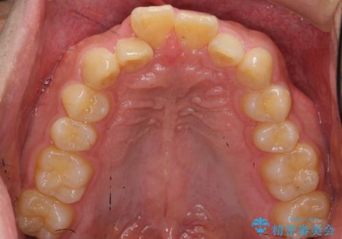 出っ歯を治したい 深いかみあわせ インビザラインで治療の治療前