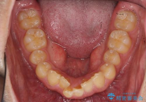 出っ歯を治したい 深いかみあわせ インビザラインで治療の治療前