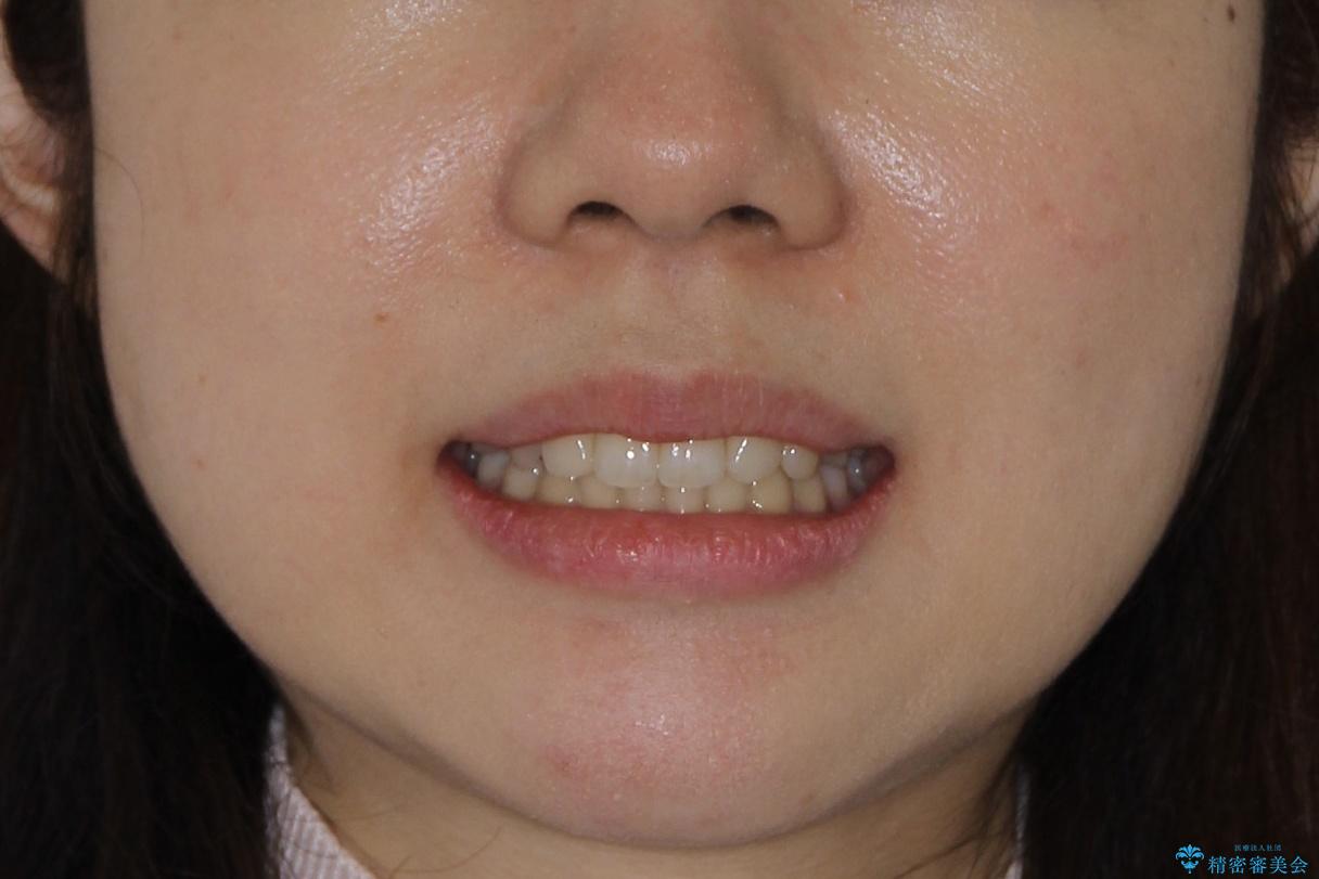 押しつぶされた歯列、アーチの拡大だけで非抜歯で改善した症例の治療後（顔貌）