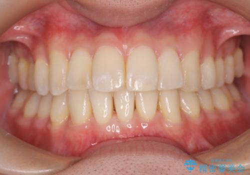前歯の重なりとガタガタをマウスピースで改善した症例の治療中