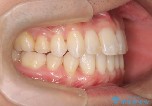 前歯の重なりとガタガタをマウスピースで改善した症例の治療中