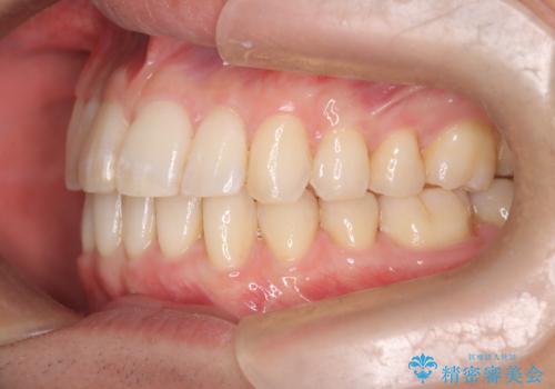 前歯の重なりとガタガタをマウスピースで改善した症例の治療中