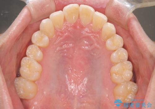 前歯の重なりとガタガタをマウスピースで改善した症例の治療中