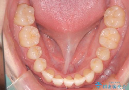 前歯の重なりとガタガタをマウスピースで改善した症例の治療中