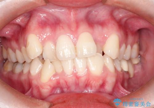 八重歯のワイヤーによる抜歯矯正　 矯正治療と並行してセラミック治療もの症例 治療前