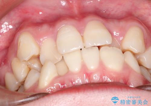 八重歯のワイヤーによる抜歯矯正　 矯正治療と並行してセラミック治療もの治療前