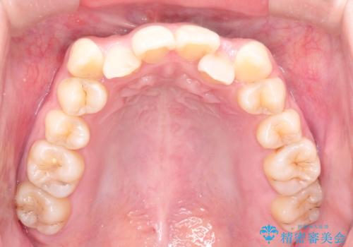 八重歯のワイヤーによる抜歯矯正　 矯正治療と並行してセラミック治療もの治療前