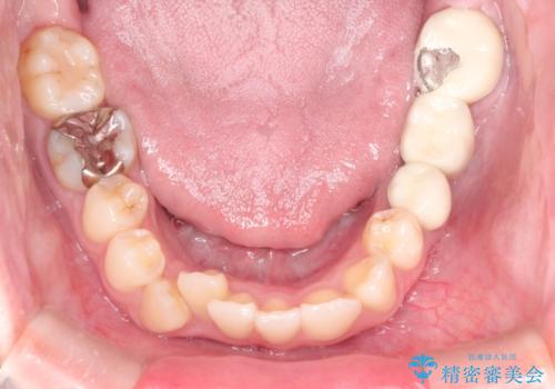 八重歯のワイヤーによる抜歯矯正　 矯正治療と並行してセラミック治療もの治療前
