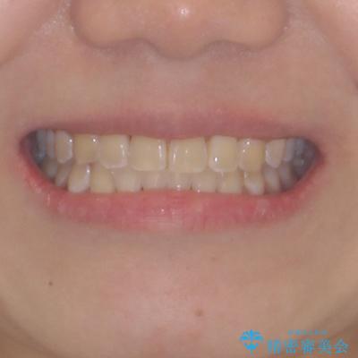 前歯の隙間と上下正中のズレを解消の治療後（顔貌）