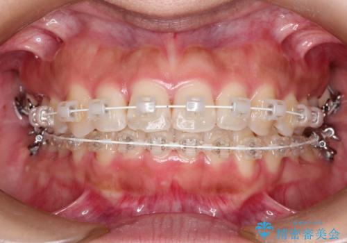 飛び出した前歯が気になる! 前歯のガタガタを抜歯をせずに治した症例の治療中