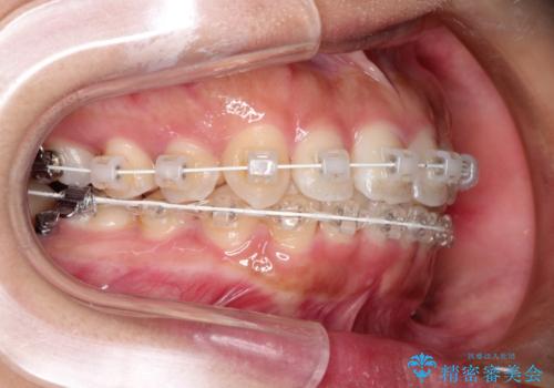 飛び出した前歯が気になる! 前歯のガタガタを抜歯をせずに治した症例の治療中