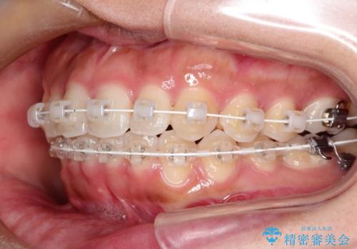 飛び出した前歯が気になる! 前歯のガタガタを抜歯をせずに治した症例の治療中