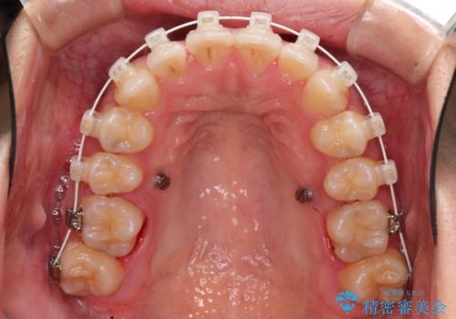 飛び出した前歯が気になる! 前歯のガタガタを抜歯をせずに治した症例の治療中