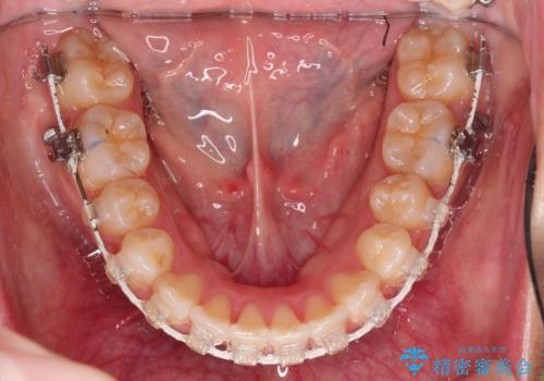 飛び出した前歯が気になる! 前歯のガタガタを抜歯をせずに治した症例の治療中