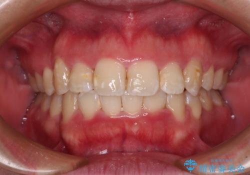 【モニター】八重歯を抜歯矯正でスッキリした口元にの症例 治療後