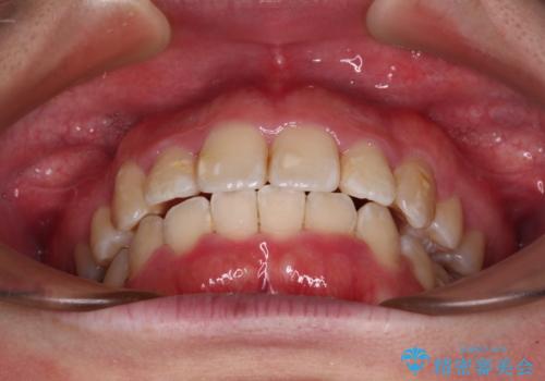 【モニター】八重歯を抜歯矯正でスッキリした口元にの治療後