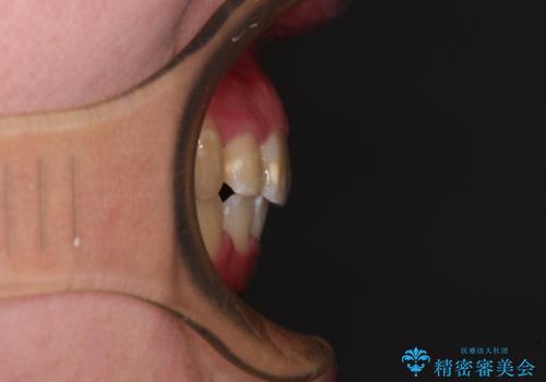 【モニター】八重歯を抜歯矯正でスッキリした口元にの治療後