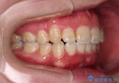 【モニター】八重歯を抜歯矯正でスッキリした口元にの治療後