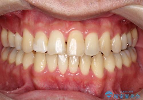 再矯正症例 前歯のガタガタと噛み合わせのズレをマウスピースで治した症例の治療後