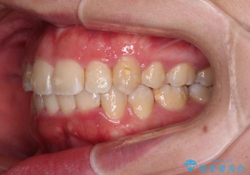 【モニター】八重歯を抜歯矯正でスッキリした口元にの治療後