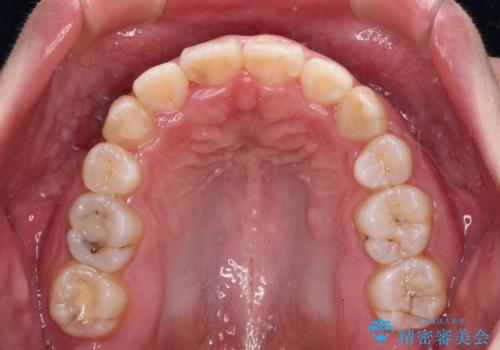 【モニター】八重歯を抜歯矯正でスッキリした口元にの治療後