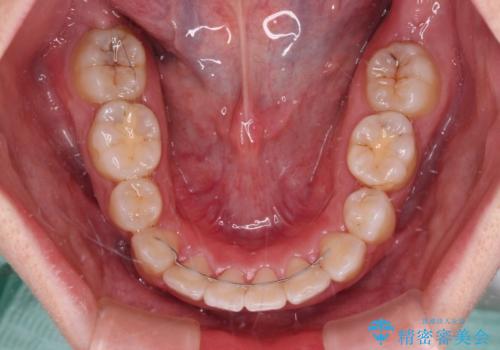 【モニター】八重歯を抜歯矯正でスッキリした口元にの治療後
