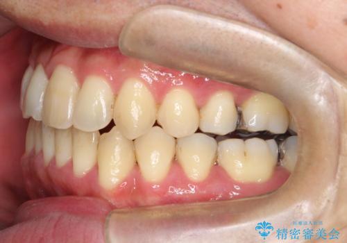 再矯正症例 前歯のガタガタと噛み合わせのズレをマウスピースで治した症例の治療後