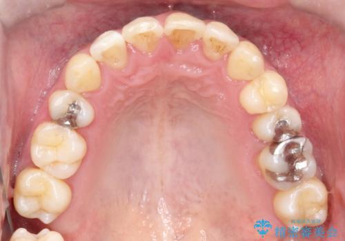 再矯正症例　前歯のガタガタと噛み合わせのズレをマウスピースで治した症例の治療後